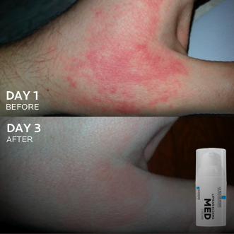 Lipikar Eczema 3 days